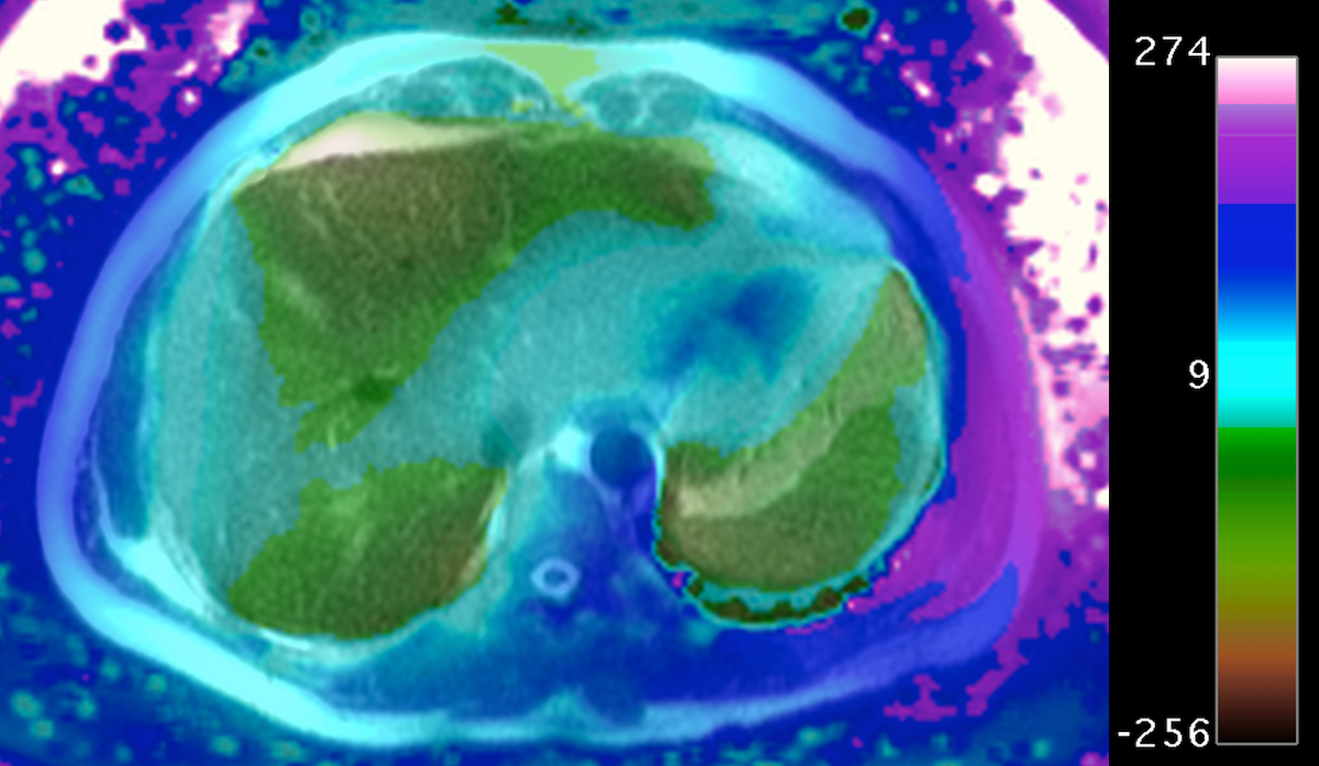 Field map (Hz) in the abdomen acquired using the IDEAL-IQ
