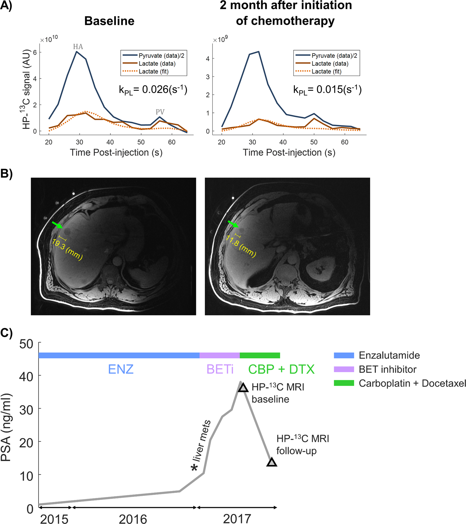 Clinical Translation of HP 13C MRI in a patient with liver metastases from prostate cancer